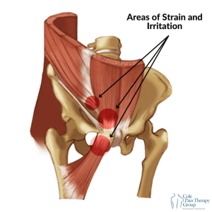 What is a Sports Hernia
